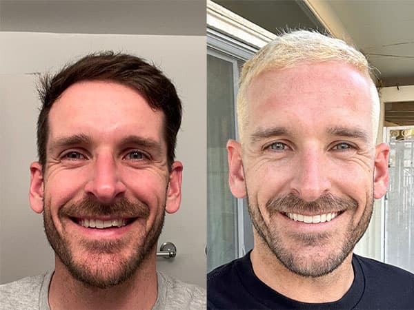 Average Cost of Invisalign® Aligners | Invisalign.com