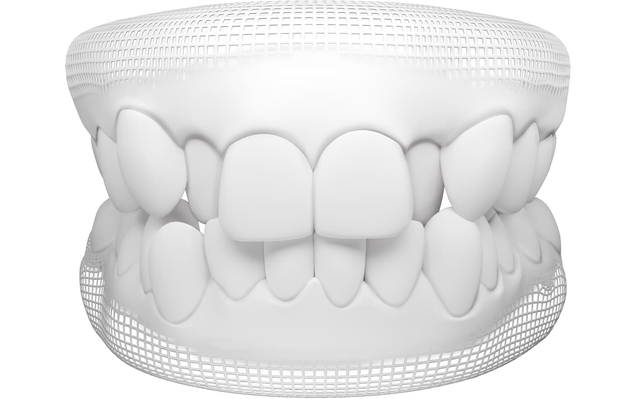 Invserlin Tooth Invisalign Treatment for Teeth Crowding |Invisalign® clear aligners