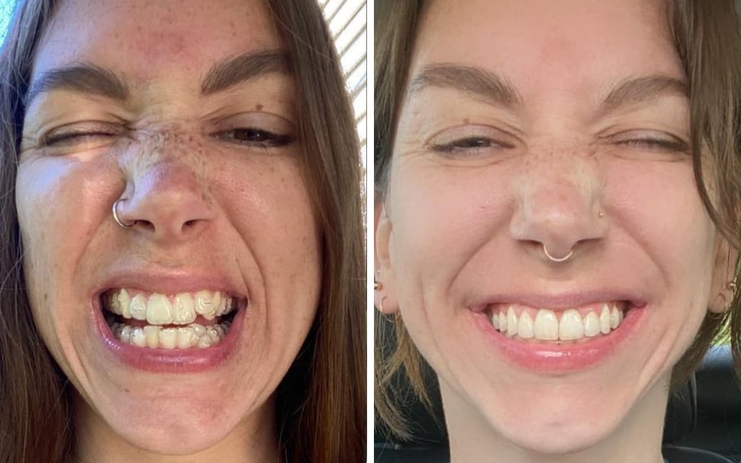 Invisalign Tooth Extraction Invisalign Treatment for Teeth Crowding |Invisalign® clear aligners
