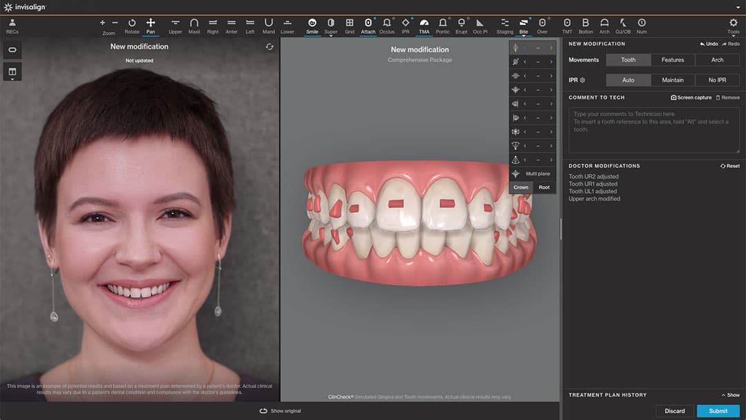 Invasalign System Invisalign® aligners technology | Align Technology | Invisalign.com