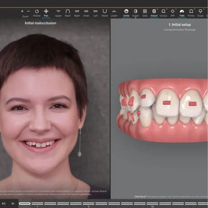 Invisalign® Digital Treatment For Aligners | Invisalign.com