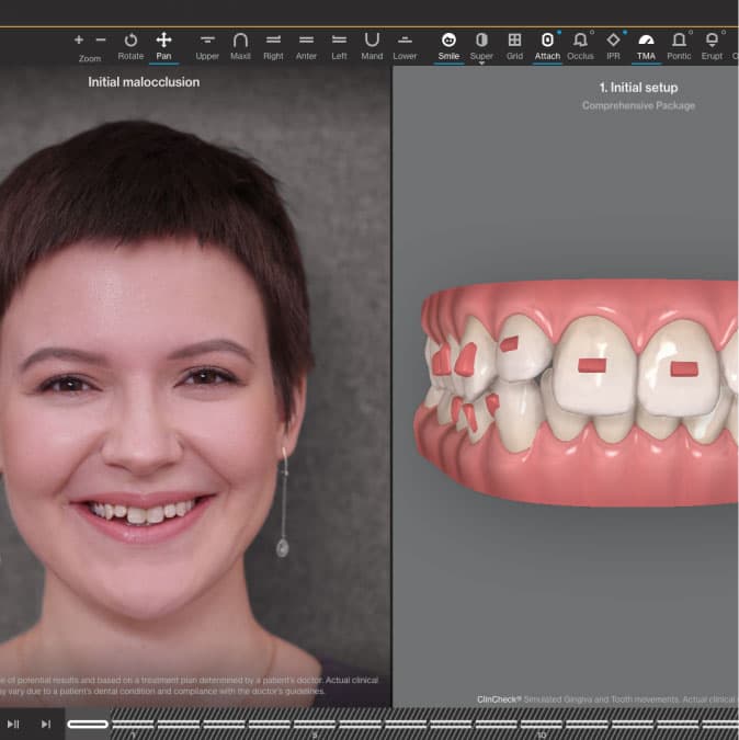 Invisalign® Digital Treatment For Aligners | Invisalign.com