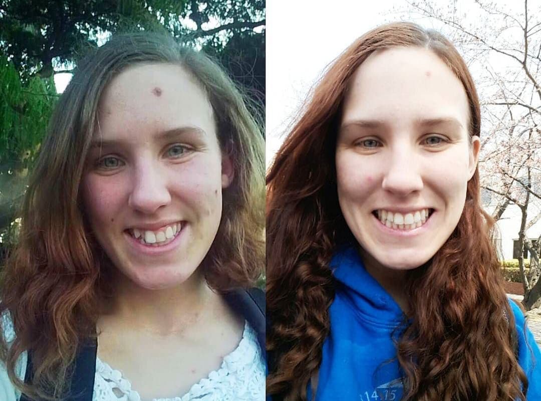 Overbite causes and treatment with Invisalign aligners