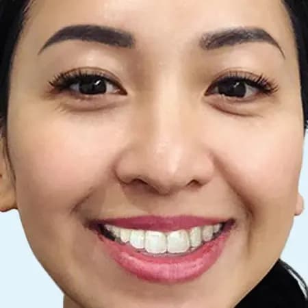 My Invisalign™ App | Invisalign.com