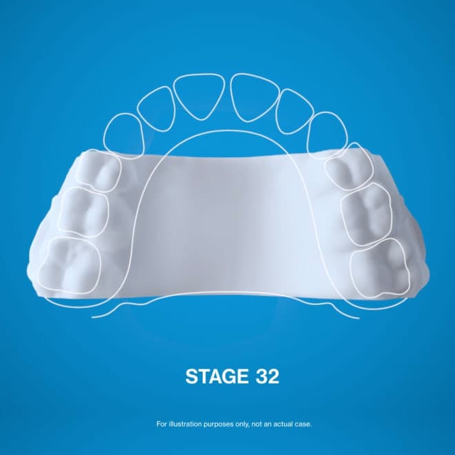 Invisalign® Palatal Expander | Invisalign.com