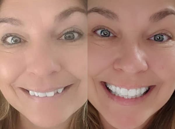 Overbite causes and treatment with Invisalign aligners